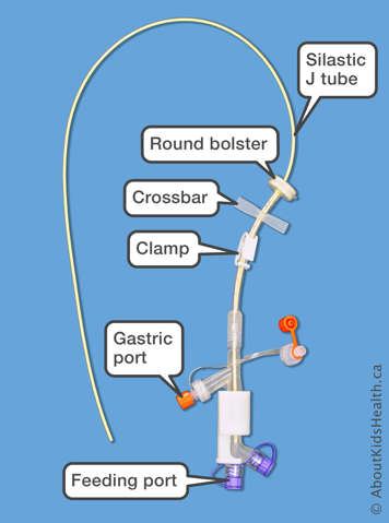 Parts of the Corflo PEG J Tube