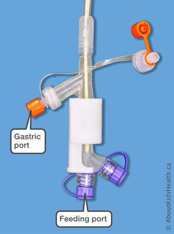 Feeding port and gastric port on a Corflo PEG J Tube