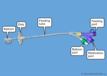 Parts of a Kangaroo G tube