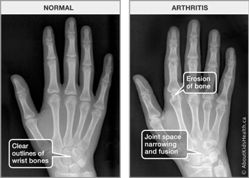 X-rays of normal hand with clear outlines of bones and of arthritic hand with bone erosion, joint space narrowing and fusion