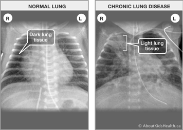 X-ray of normal lungs with dark lung tissue and X-ray of lungs affected by chronic lung disease with light lung tissue