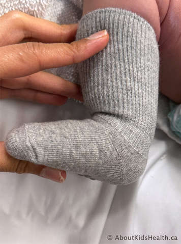 Child with clubfoot with caregiver bending the child&rsquo;s knee and flexing the ankle upward