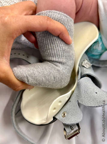Child with clubfoot with caregiver bending the child&rsquo;s knee and flexing the ankle upward as they place the foot into the boot