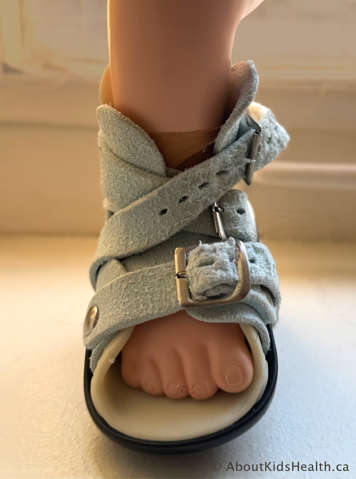 An alternative buckling method to help get a snug fit