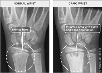 X-ray of normal wrist bone and x-ray of CRMO wrist with an inflamed area with cysts and bone destruction