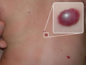 Raised red spots on a person's back