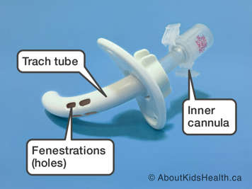 Parts of a tracheostomy tube with fenestration