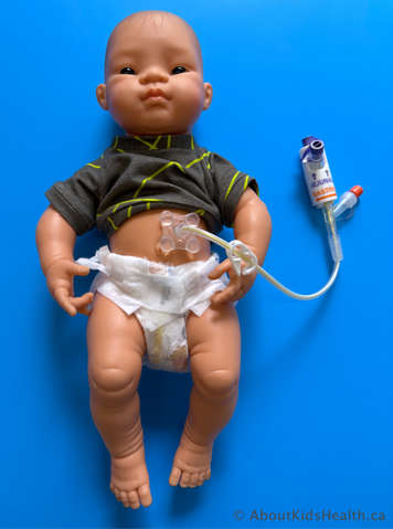 MIC PEG J tube on a baby