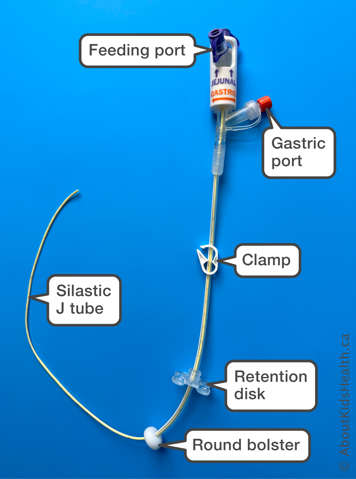MIC PEG J tube showing feeding port, gastric port, clamp, retention disk, round bolster and Silastic J tube