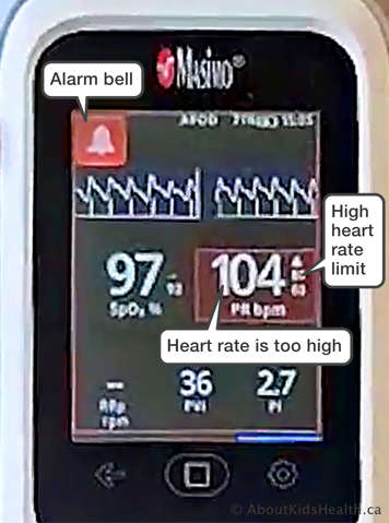 A Masimo Rad-G Oximeter showing the alarm bell highlighted in red and a high heart rate that is also highlighted in red