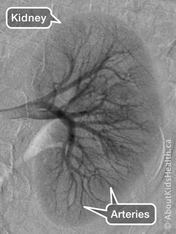 Identification of kidney and arteries in a kidney angiogram