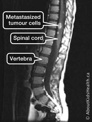 A scan showing the vertebra and spinal cord with metastases