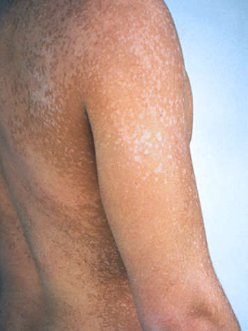 Teen with tinea versicolor fungal infection on back, shoulders and arms