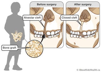 Soft bone is taken from the iliac crest and placed in the alveolar cleft