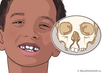 Bilateral alveolar cleft