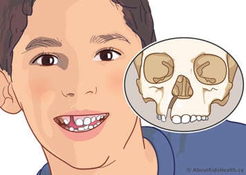 Unilateral alveolar cleft