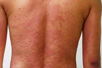 Maculopapular rash on a person's back