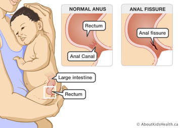 The large intestine and rectum in a baby, a normal anus with clear rectum and anal canal, and an anus with a tear