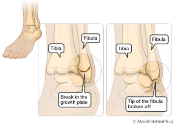 Ankle with break in the growth plate and ankle with tip of the fibula broken off