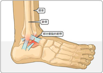 脛骨，腓骨，部分撕裂的韌帶