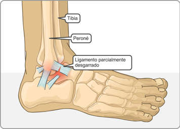 La tibia, el peroné y un ligamento del tobillo parcialmente desgarrado