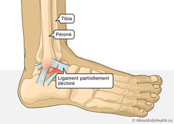 Le tibia, le péroné et un ligament dans la cheville partiellement déchiré