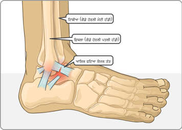 ਟਿਬੀਆ, ਫਿਬੁਲਾ ਅਤੇ ਗਿੱਟੇ ਵਿੱਚ ਅੰਸ਼ਿਕ ਰੂਪ ਨਾਲ ਪਾਟਿਆ ਹੋਇਆ ਲਿਗਾਮੈਂਟ