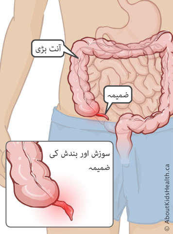 جسم میں بڑی آنت اور اپنڈکس کا مقام اور ایک بند اور سوجی ہوئی اپنڈکس کی تصویرکشی