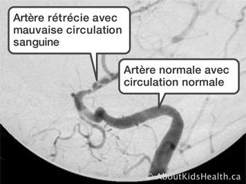 Artère rétrécie avec mauvaise circulation sanguine et artère normale avec circulation normale