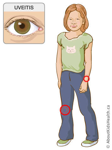 Identification of the wrist and knee joints on a girl&rsquo;s body, and illustration of an eye affected by uveitis