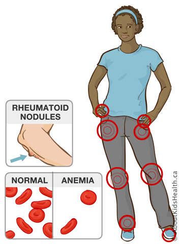 Identification of finger, hip, knee, ankle and toe joint and illustration of rheumatoid nodules on arm