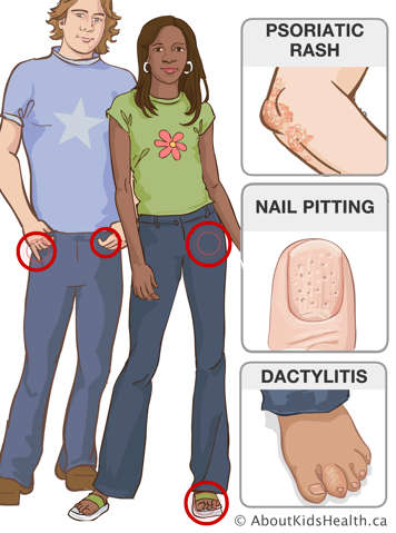 Identification of finger, hip and toe joints and illustrations of psoriatic rash, nail splitting and dactylitis