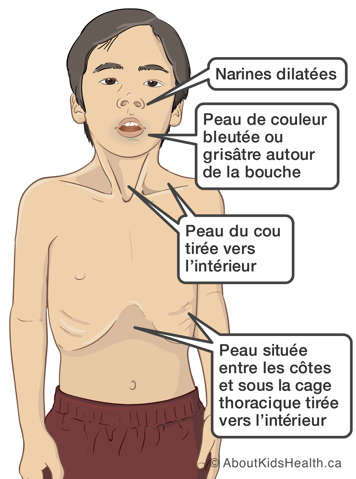 Child displaying late warning signs of asthma