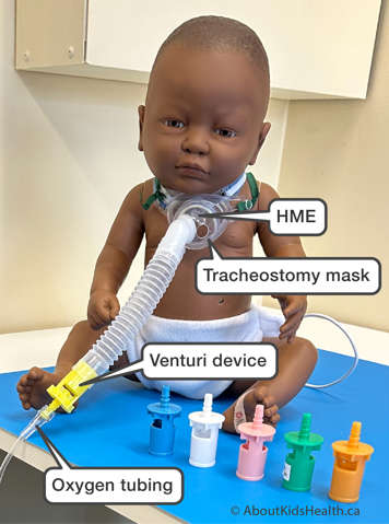 Child with a tracheostomy with a tracheostomy mask with a Venturi device attached to it