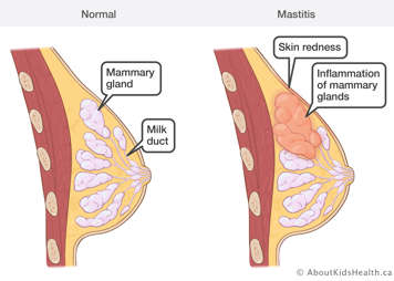 Comparison of a normal breast and a breast with mastitis