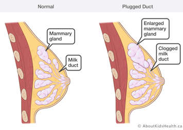 Comparison of a normal breast and a breast with a plugged duct