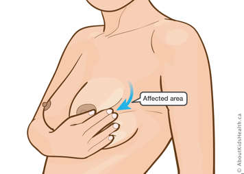 Massaging a breast with a plugged duct, from behind the lumpy area towards the nipple