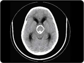 CT scan of brain