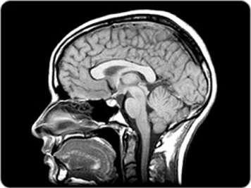 IRM neurologique d'une vue sagittale