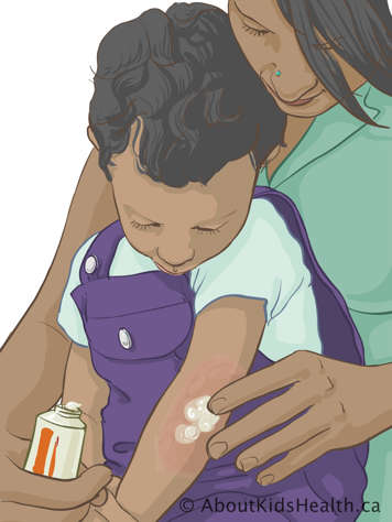 Applying cream to child’s elbow