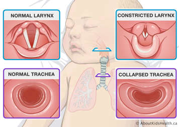 A normal larynx and constricted larynx and a normal trachea and collapsed trachea in a baby