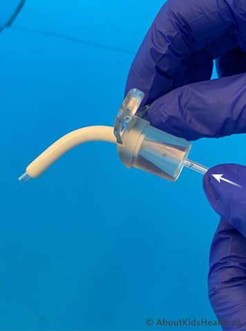 Using a back up tracheostomy tube that is the same size to measure the length of the suction catheter