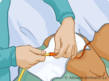 Disconnecting catheter from drainage tubing