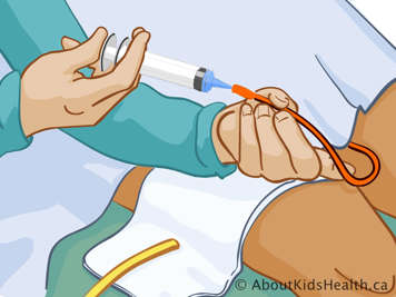 Injecting saline solution into catheter with a syringe