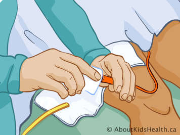 Cleaning tip of catheter with alcohol swab