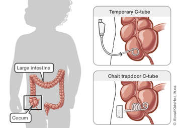 Illustration of a temporary C-tube in the cecum and a chait trapdoor C-tube in the cecum