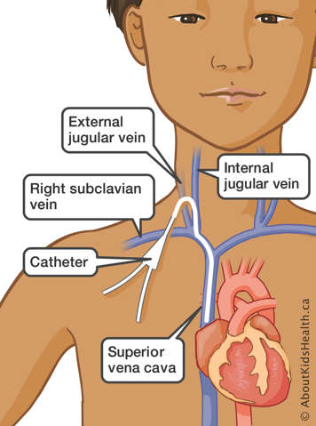 Catheter running through the superior vena cava, right subclavian vein and internal and external jugular veins