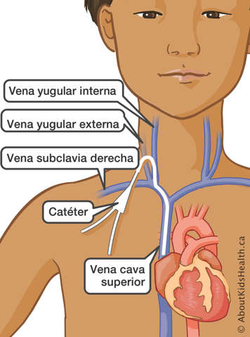 Un catéter en las venas yugulares externa e interna, en la vena subclavia derecha y en la vena cava superior