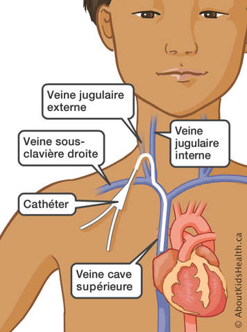 Un cathéter passant dans la veine cave supérieure, la veine sous-clavière droite et les veines jugulaire interne et externe