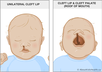 Baby with a split in the lip up into the nose and a baby with mouth open showing a split in the lip and roof of the mouth